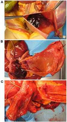 Case Report: Sudden Fatal Hemorrhage in Ulcerative Fungal Laryngotracheitis—A Pediatric Case Report